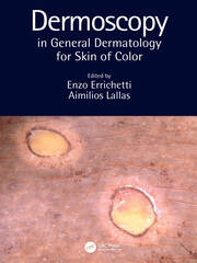 Dermoscopy in General Dermatology for Skin of Color image