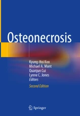 Osteonecrosis image