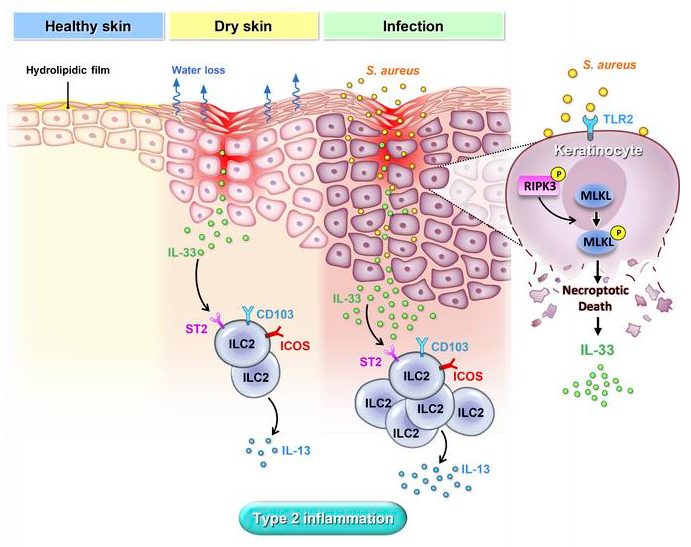 Staphylococcus aureus exacerbates dermal IL-33-ILC2 axis activation through evoking RIPK3/MLKL-mediated necroptosis of dry skin